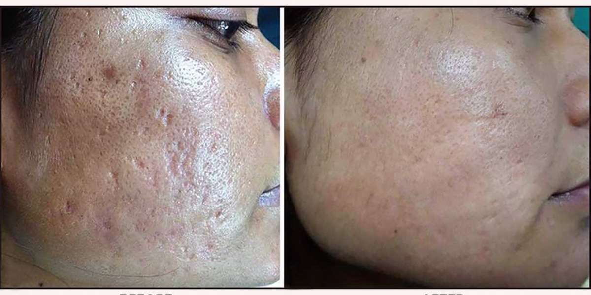 Microneedling Results