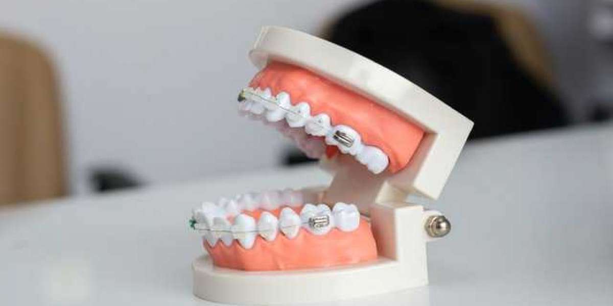 Best Dental Implant Dubai