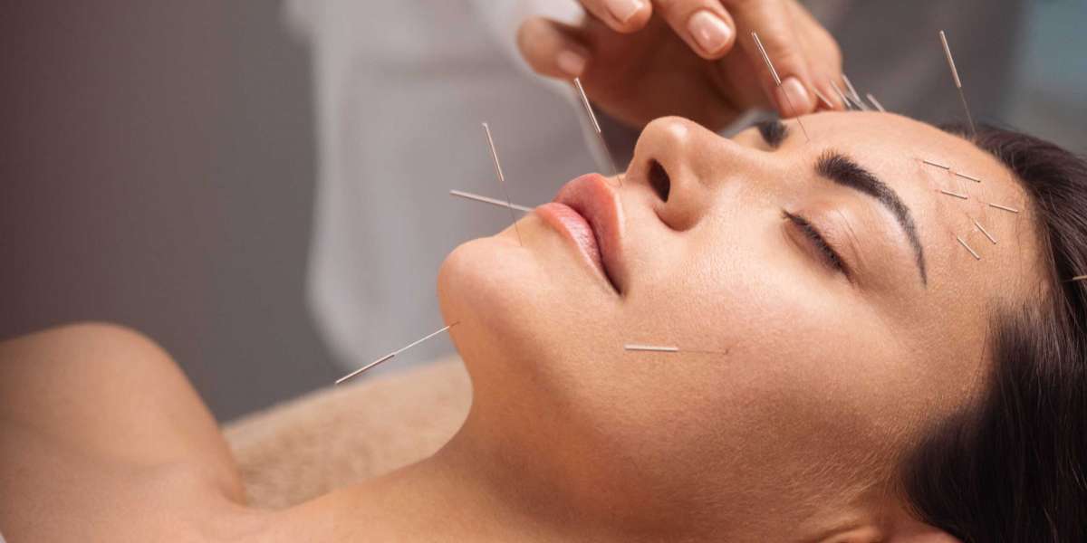 Navigating the Path to Wellness: Discovering Acupuncture Near Me