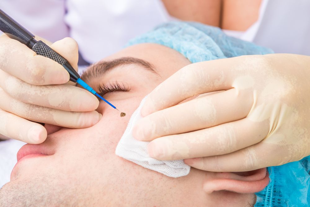 Understanding Mole Removal Costs: What to Anticipate