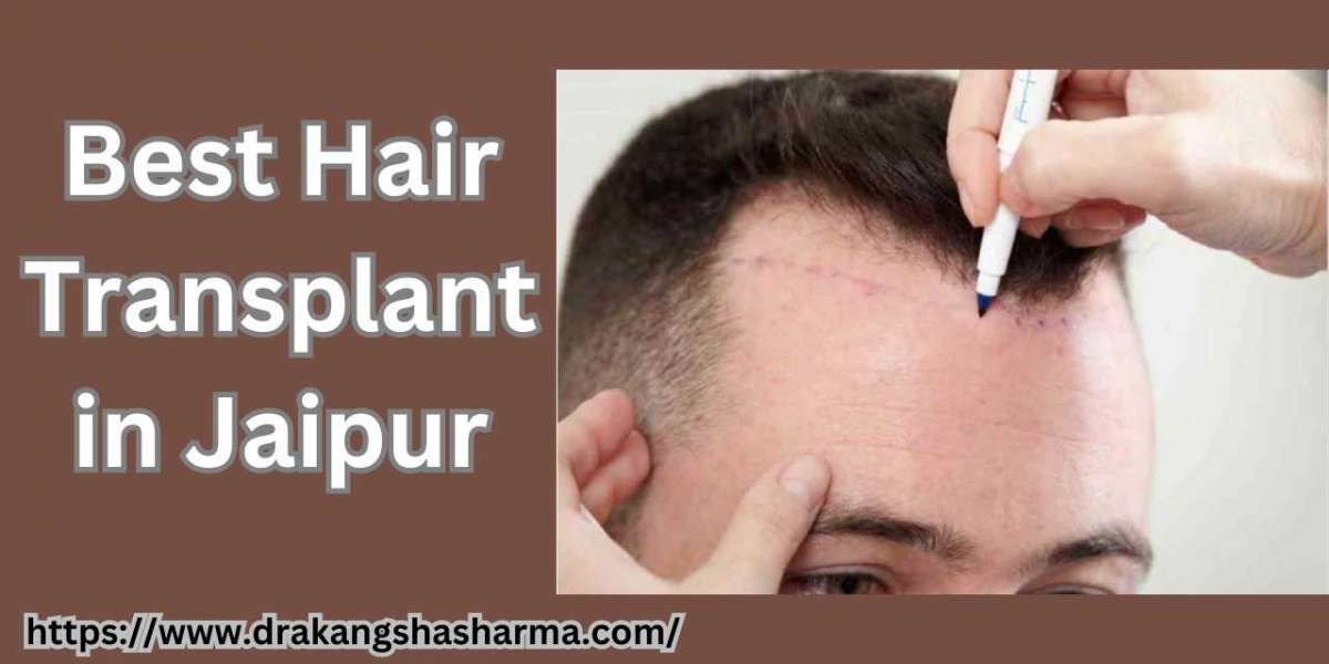 Worried About Hair Shedding After a Hair Transplant? Read This Article