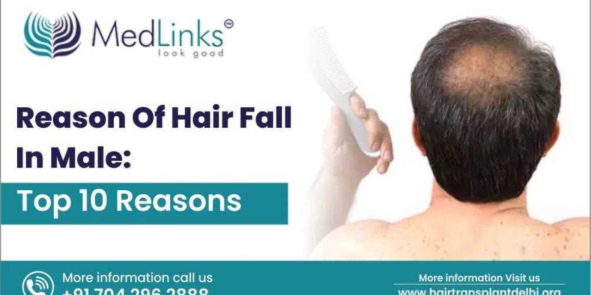 Reason for Hair Fall in Males: Top 10 Reasons