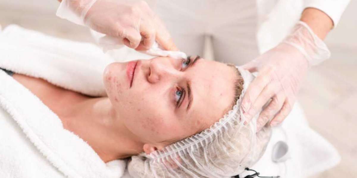 Discover Radiance: Exploring the Best Acne Facial Treatments in Singapore