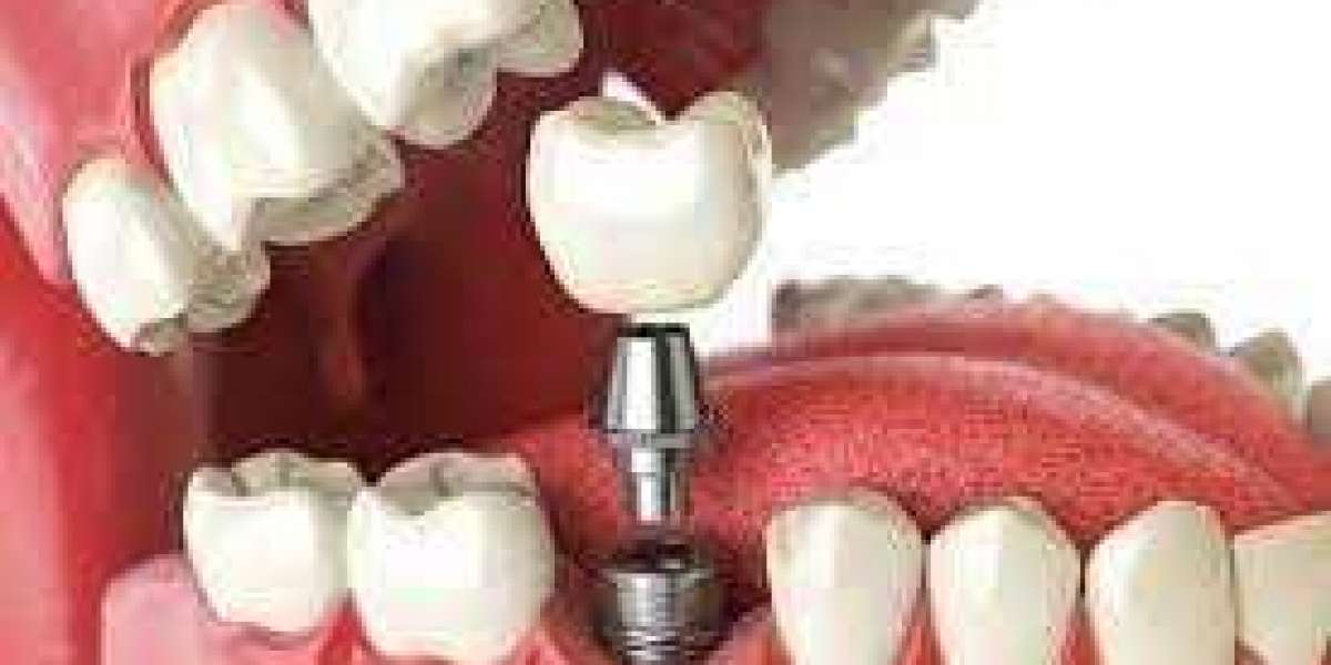 Unveiling the Price of a Perfect Smile | Dental Implant Costs in UAE