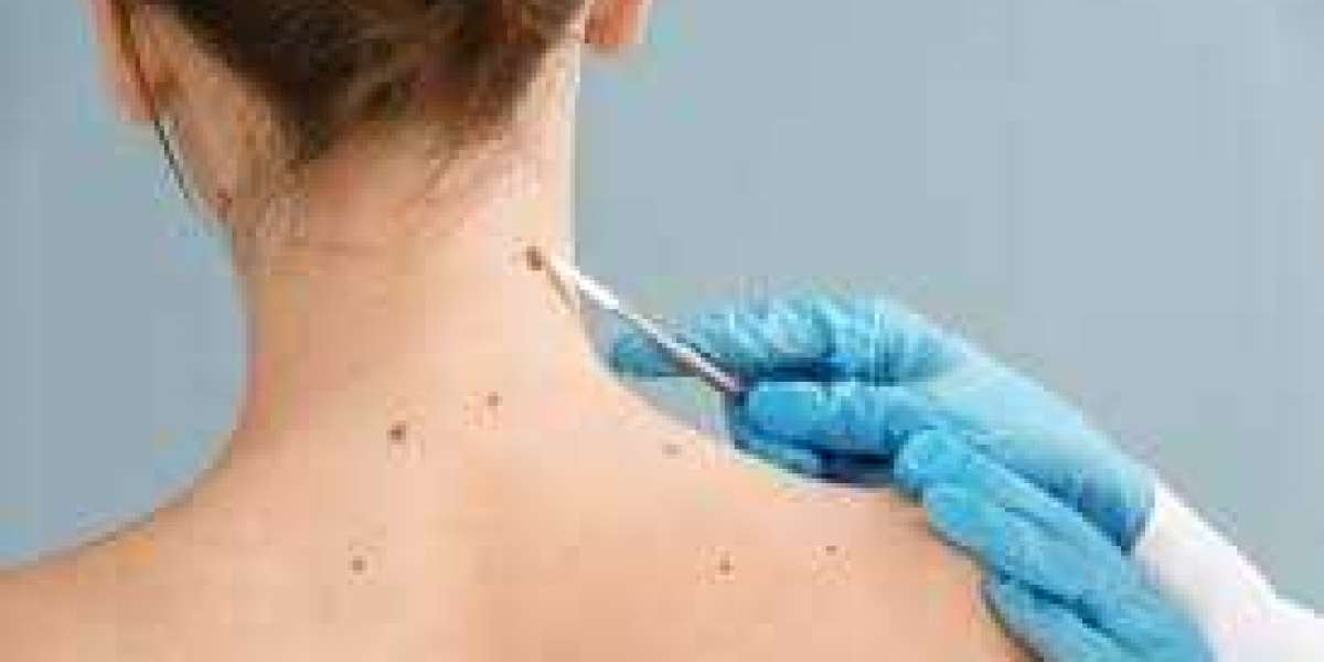 Skin Tag Removal in Noida: Safe and Effective Solutions for Skin Concerns