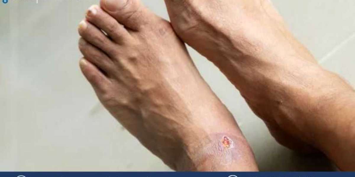Diabetic Foot Ulcers Market Size, Share, Trends, Outlook, Growth, Analysis, Report and Forecast 2024-2032
