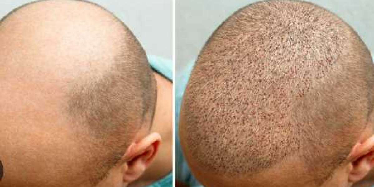 Hair Transplant cost in Bangalore