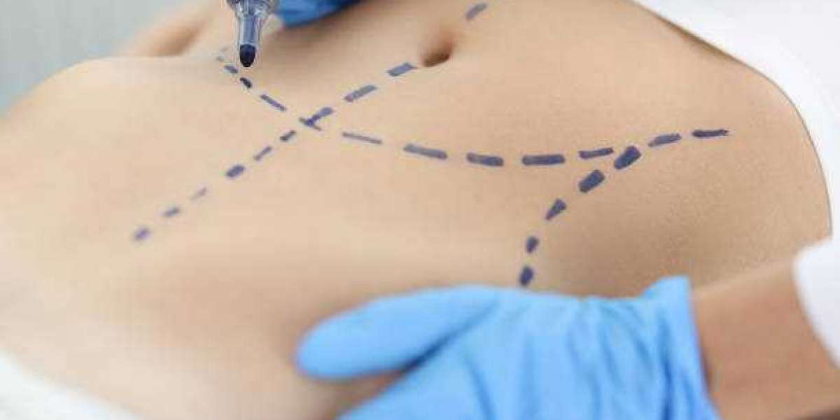 Dubai's Liposuction Landscape: Insights into the Procedure and Recovery