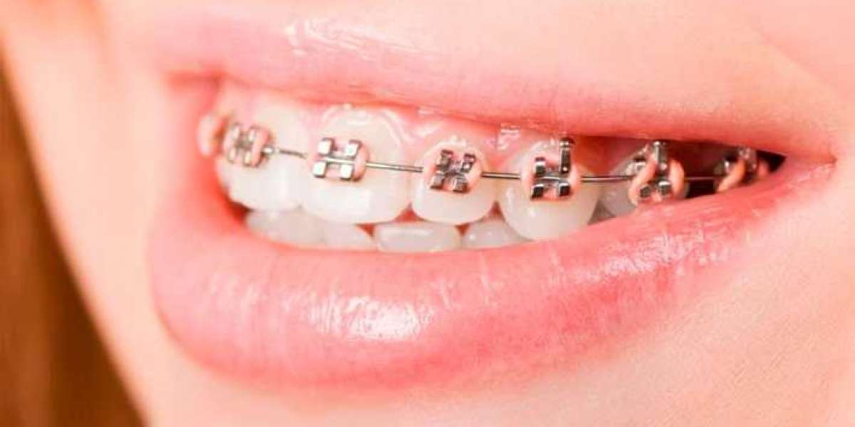 Finding the Best Teeth Alignment Prices in Riyadh