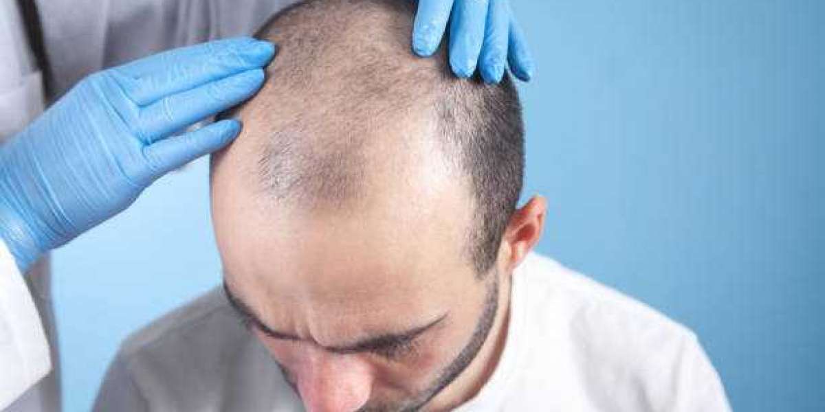 The cost of hair transplantation and any other relevant information should be understood