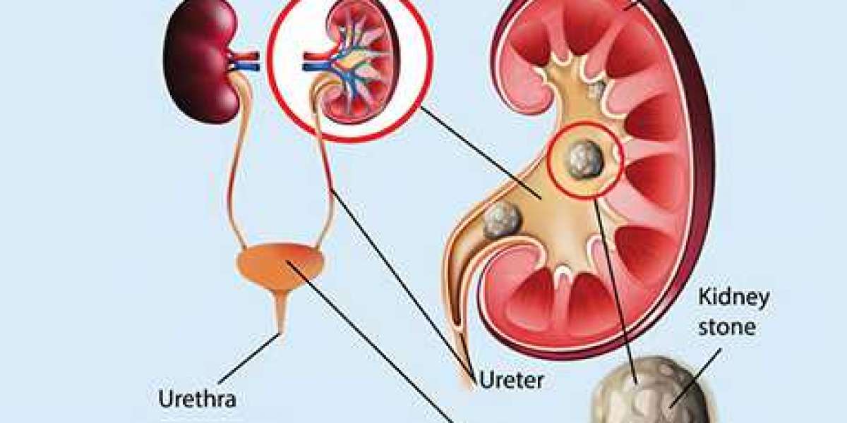 What is the best treatment for a kidney stone?