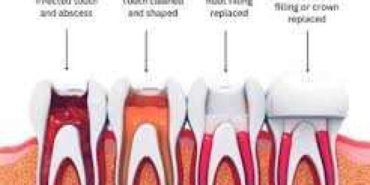 How to Treat a Root Canal in Brampton: Your Comprehensive Guide