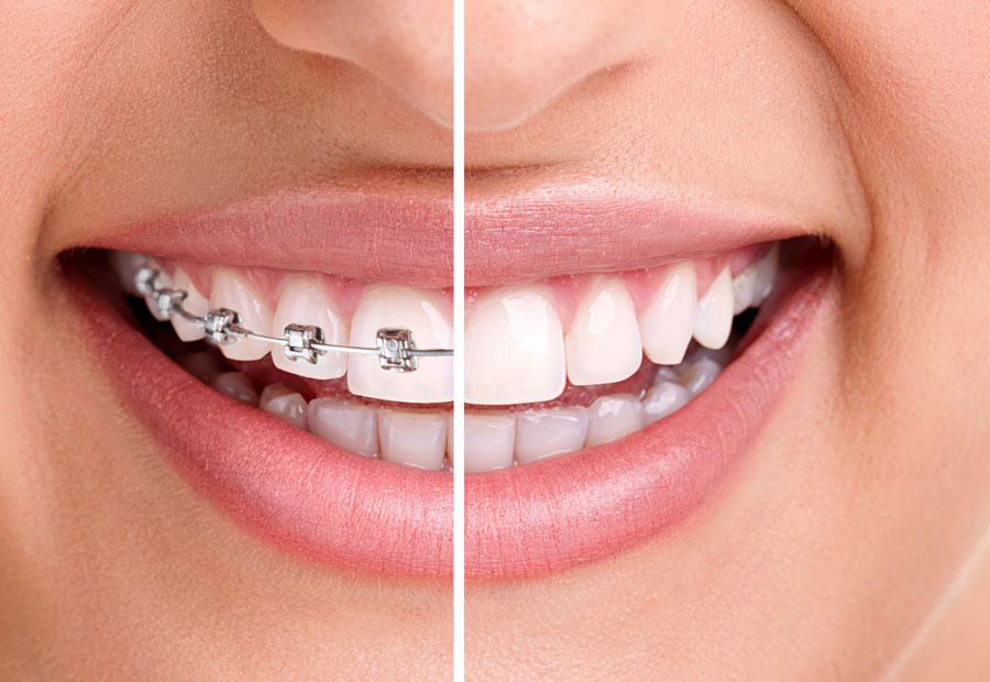 Orthodontics In Abu Dhabi | Metal Braces & Braces Adjustment