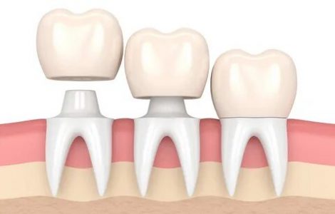 Dental Crowns in Abu Dhabi | Best Dental Crown Treatment