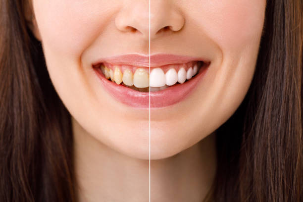 “The Dos and Don'ts of Teeth Whitening: Professional Advice” – Telegraph