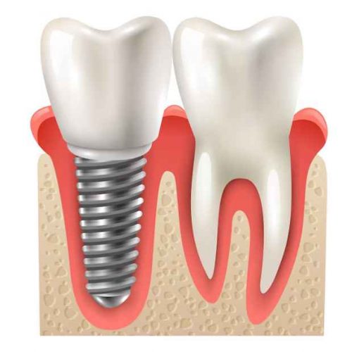 Dental Implants in Ajman: Dental Restoration