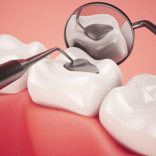 Tooth Fillings in Ajman: Dental Fillings Ajman