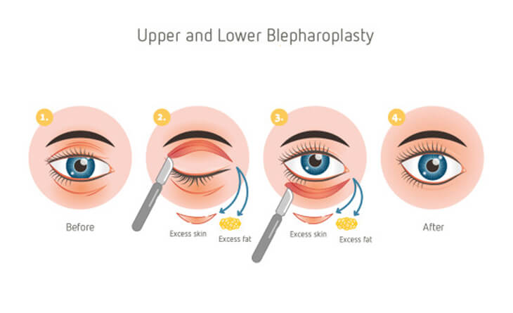 Eyelid Surgery Procedure | Care after Blepharoplasty - Dr Rajat Gupta