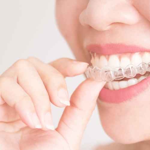 Best Invisible Aligner Provider Ajman: Clear Braces Treatment UAE