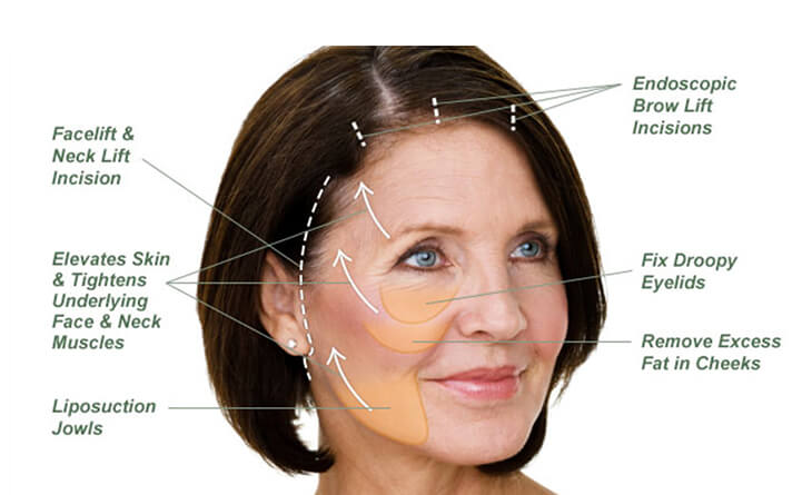Face Lift Surgery Procedure | Types of Facelifts - Dr. Rajat Gupta