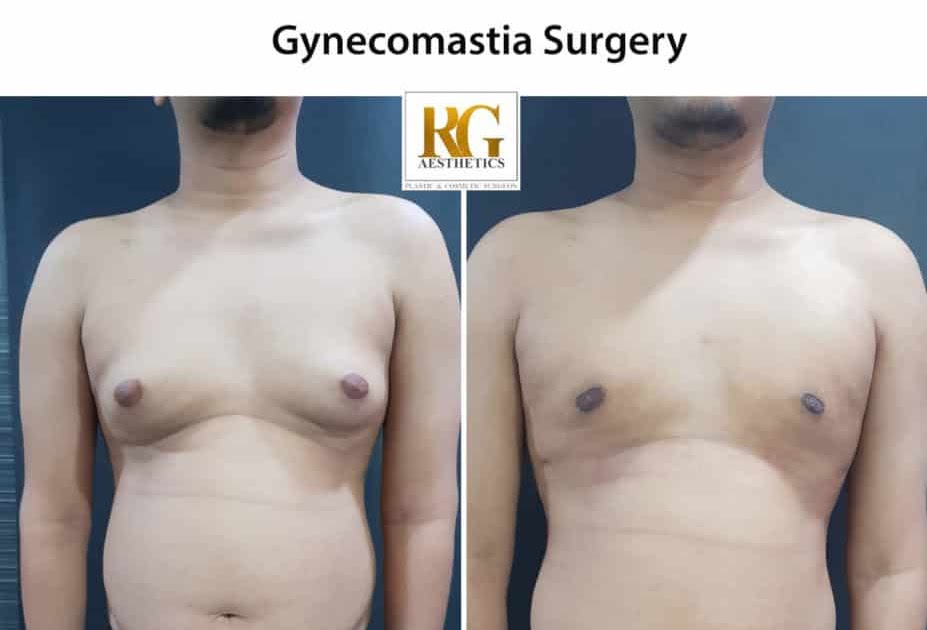 Top 5 Benefits of Gynecomastia Surgery for Men