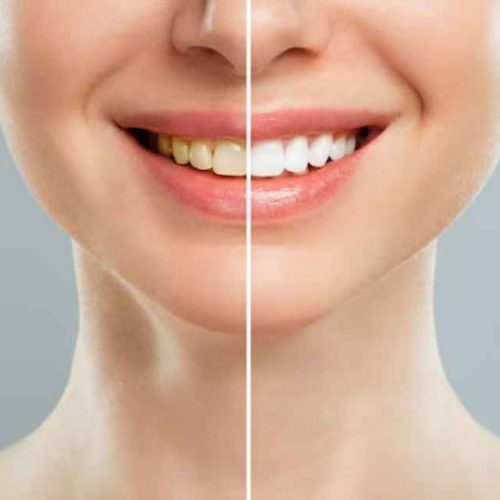 Teeth Whitening Ajman: Teeth Cleaning Ajman