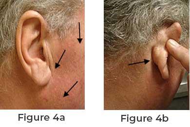 Parotid Tumors: Overview, Symptoms, Diagnosis, and Treatment | APSense.com