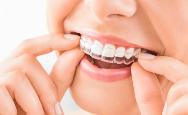 Straighten Your Teeth with Invisalign in Glendale CA | by Goorthopasadenaca | Mar, 2025 | Medium