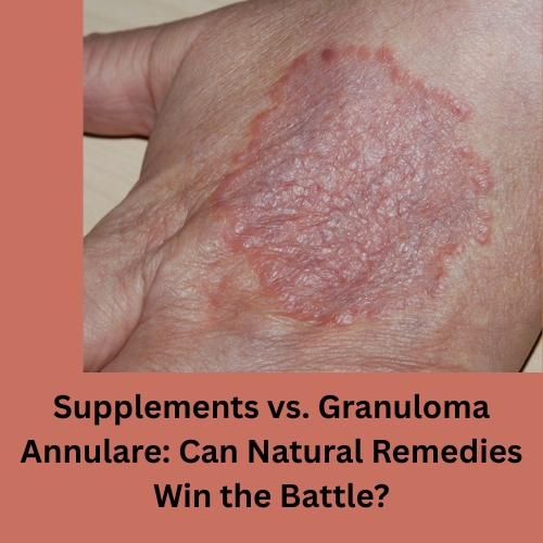 Supplements vs. Granuloma Annulare: Natural Remedies Win the Battle?