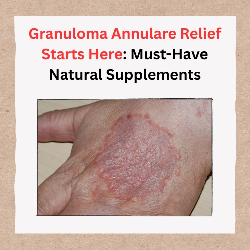 Granuloma Annulare Relief Starts Here: Must-Have Natural Supplements - Fresh Voice Hub- Guest Posting Site