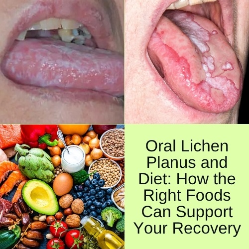 Oral Lichen Planus and Diet: How the Right Foods Can Support Your Recovery - Herbs Solutions By Nature Blog