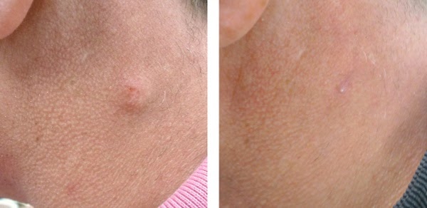 Understanding the Cost of Lipoma and Cyst Removal in London